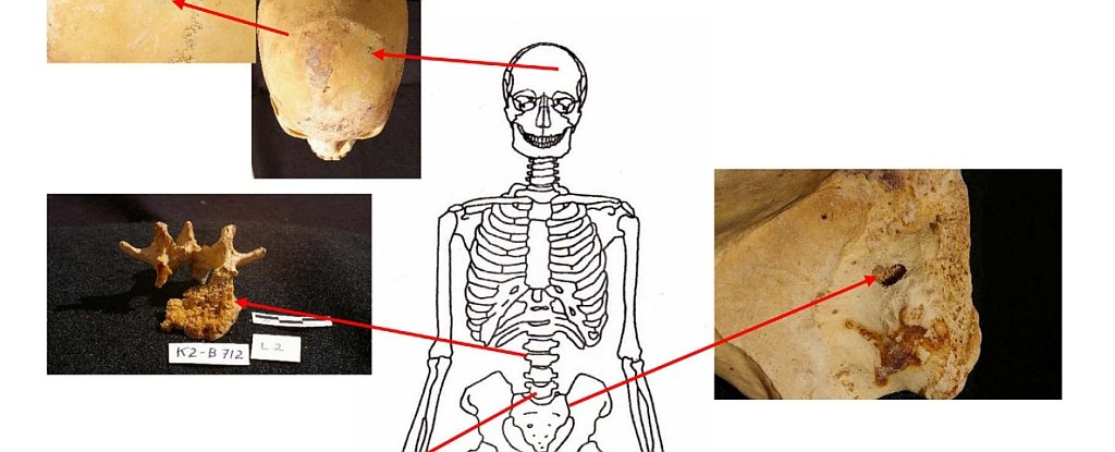 Six skeletons with signs of cancer found in an ancient Egyptian cemetery