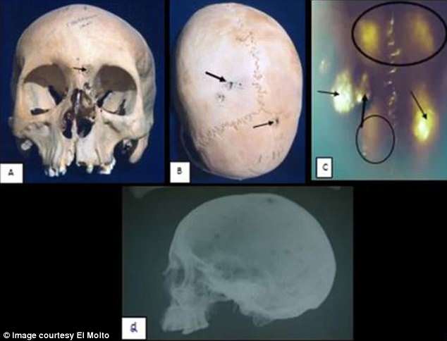 Scientists analysed ancient remains for lesions that some cancers leave on bone, and used these marks to roughly diagnose each case. One woman in her 20s suffered from cancer that had spread to her skull (arrows point to lesions). She may have had HPV