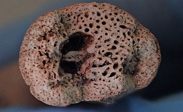 Paget's disease of bone is a common disorder that interferes with the body's natural bone recycling process. It causes new bone to be generated faster than normal — but such is softer and weaker than it should be (Pictured: a collarbone showing visible signs of the condition)