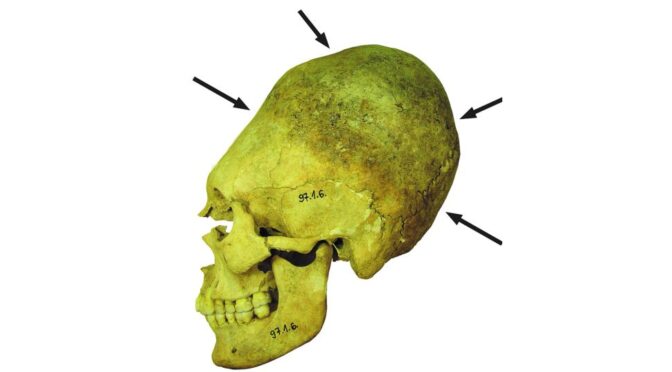 Deformed ‘alien’ skulls offer clues about life during the Roman Empire’s collapse
