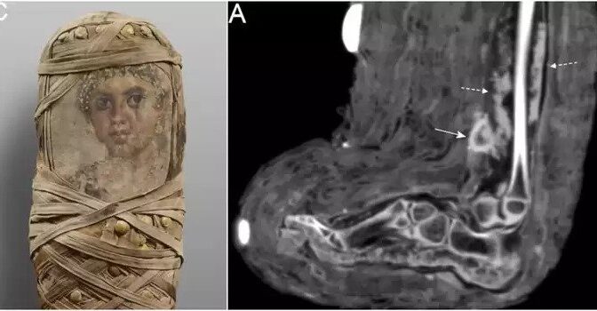 A child mummy from Egypt is the first found with a dressed wound, offering a rare glimpse into ancient medicine