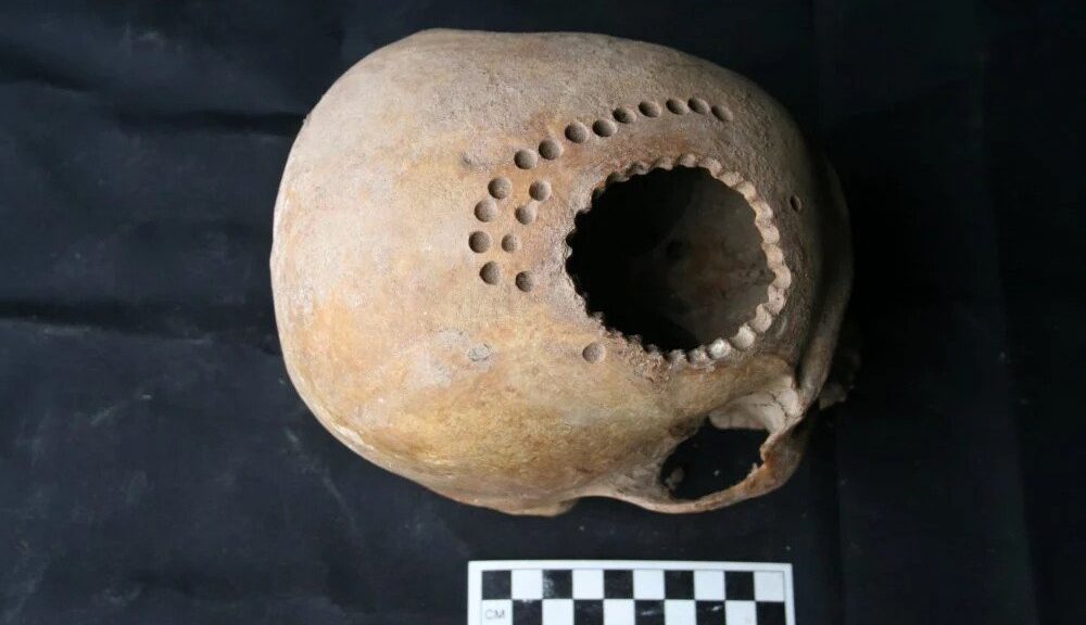 1,000 Years Ago, Patients Survived Brain Surgery, But They Had To Live With Huge Holes in Their Heads