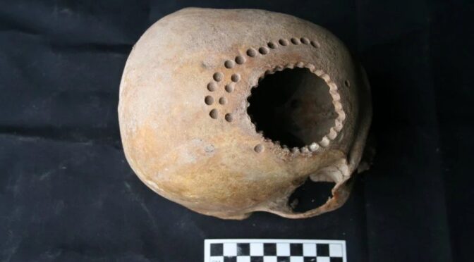 1,000 Years Ago, Patients Survived Brain Surgery, But They Had To Live With Huge Holes in Their Heads