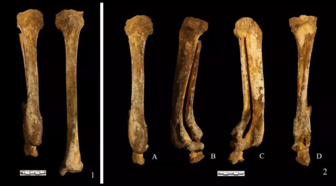 Ancient Chinese woman faced brutal ‘yue’ punishment, had foot cut off, and a skeleton reveals