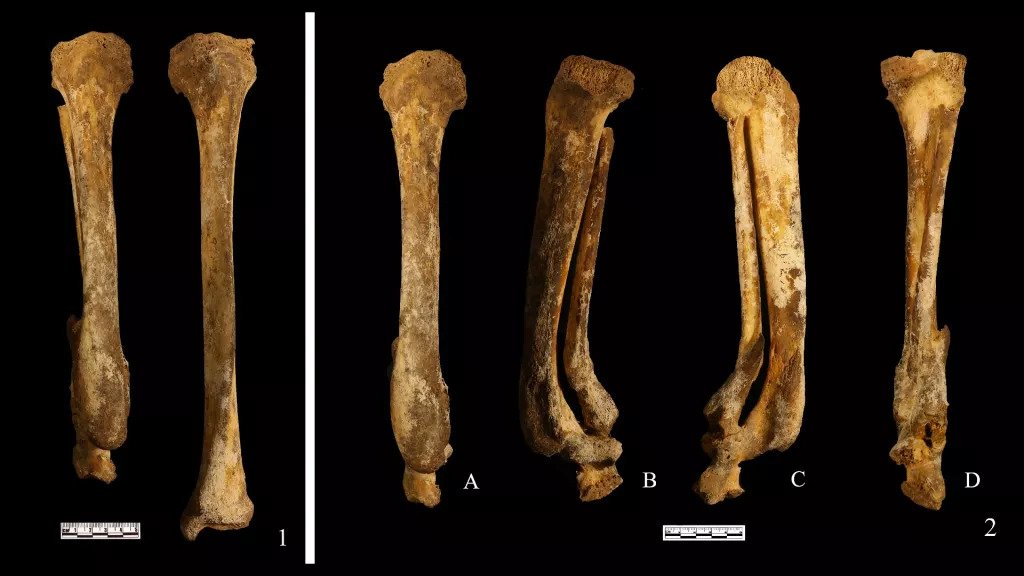 Ancient Chinese women faced brutal 'yue' punishment, had foot cut off, and a skeleton reveals