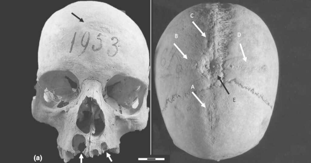 An unlucky medieval woman underwent at least two skull surgeries in Longobard Italy