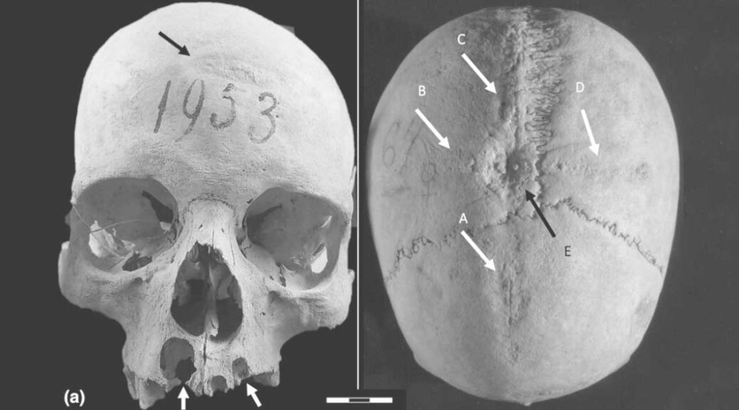 An unlucky medieval woman underwent at least two skull surgeries in Longobard Italy
