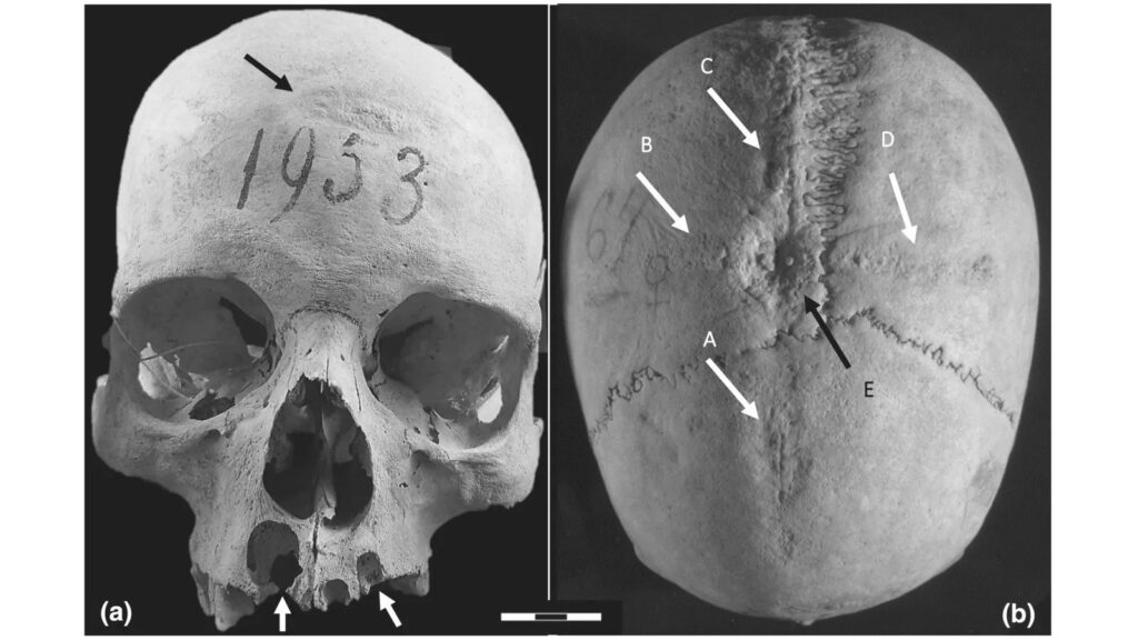 Signs of Surgery Examined on Medieval Woman’s Skull